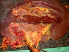 肝臓の画像