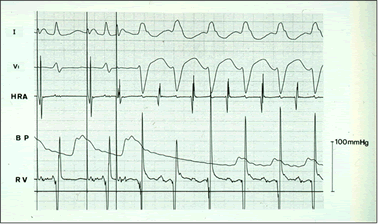 心臓電気生理検査：ペーシング刺激にて頻拍を誘発