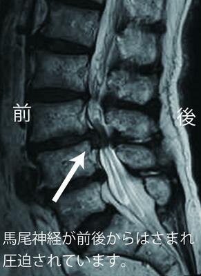 腰部脊柱管器狭窄症