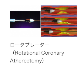 ロータブレーター（Rotational Coronary Atherectomy）