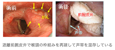 機能温存手術の一例：下咽頭がんに対する喉頭温存手術