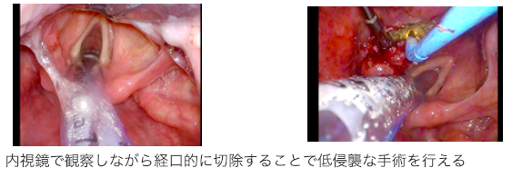 喉頭がんに対する経口的内視鏡手術