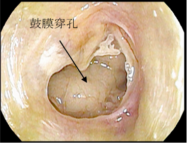 手術前（右耳、大穿孔）
中等度難聴(53.8dB)
