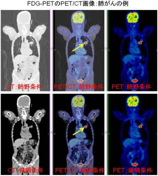 FDG-PETのPET/CT画像：肺がんの例
