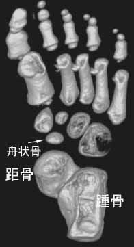 内反足2
