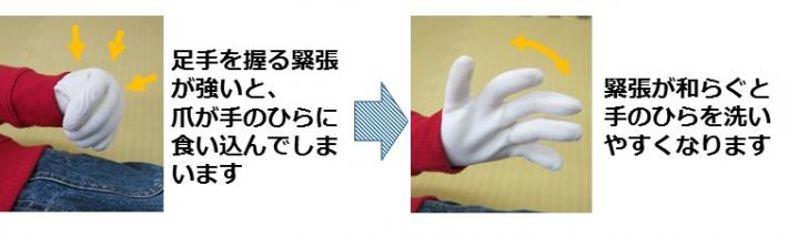痙縮の手