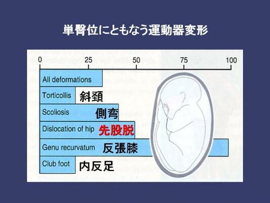 単臀位にともなう運動器変形