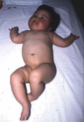 先天性股関節脱臼の赤ちゃん写真2