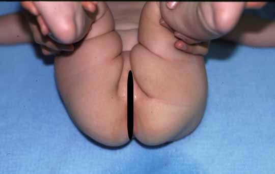 先天性股関節脱臼の赤ちゃん写真4