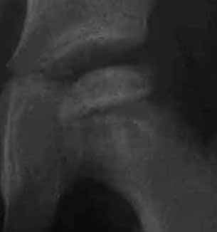 大腿骨頚部内反切り術の写真1