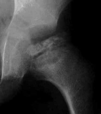 大腿骨骨切り術と骨盤骨切り術を組み合わせた場合の写真1