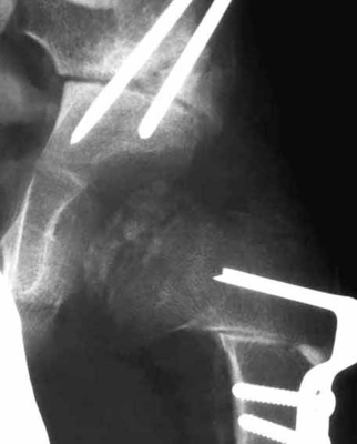 大腿骨骨切り術と骨盤骨切り術を組み合わせた場合の写真2