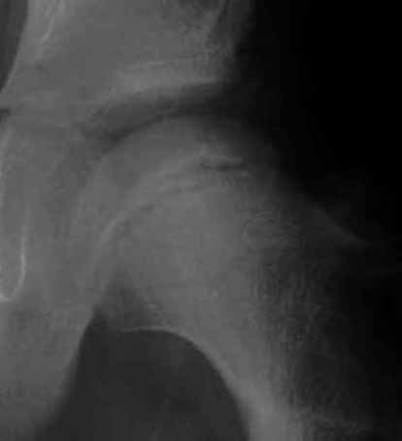 大腿骨骨切り術と骨盤骨切り術を組み合わせた場合の写真3