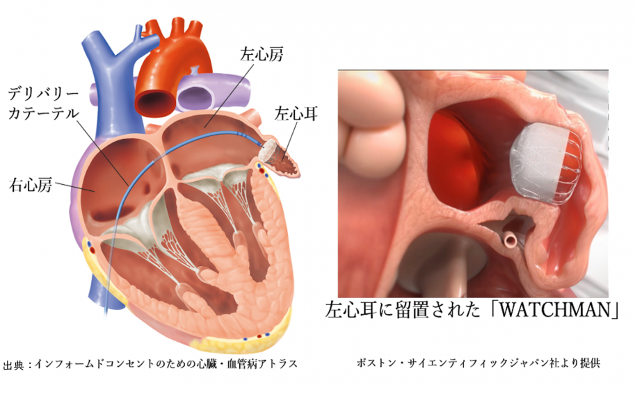 経皮的左心耳閉鎖術について画像