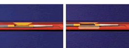 DCA(方向性アテローム切除術)