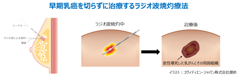 ラジオ焼灼療法として、乳房の腫瘍へニードルを挿入しラジオ波焼灼。治療後、変性壊死した乳がんとその周囲組織を示しています。