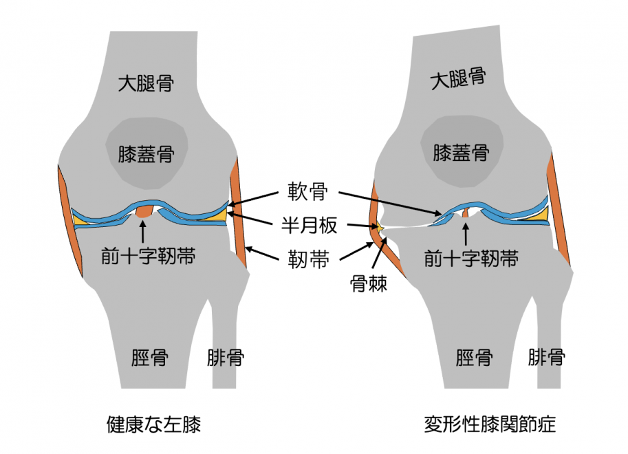 変形性膝関節症イメージ図