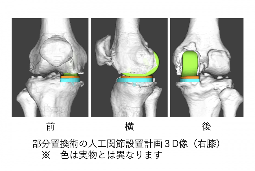 人工膝関節部分置換術