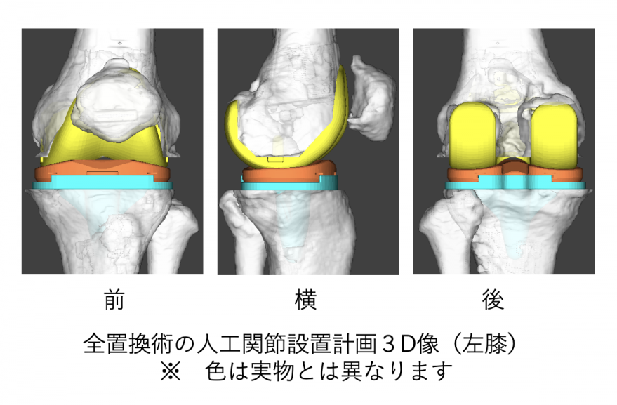 人工膝関節全置換術