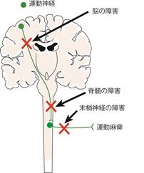 神経の障害