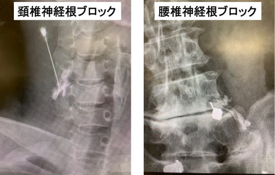 ブロック注射、トリガーポイント注射の写真