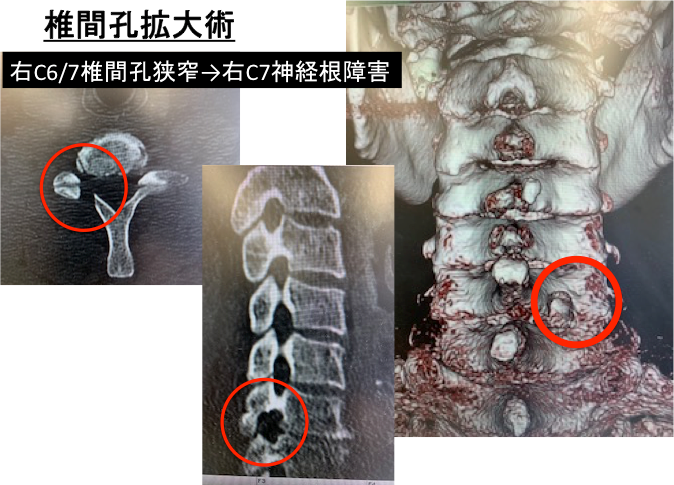椎間孔拡大術の写真