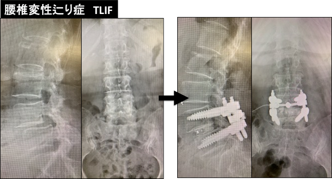 腰椎変性辷り症