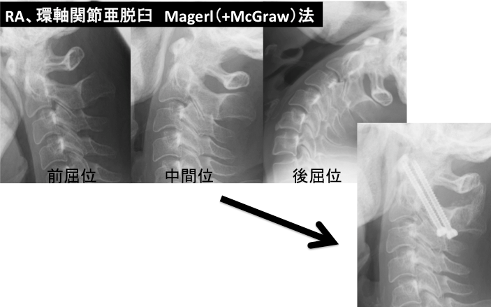 環軸関節亜脱臼法