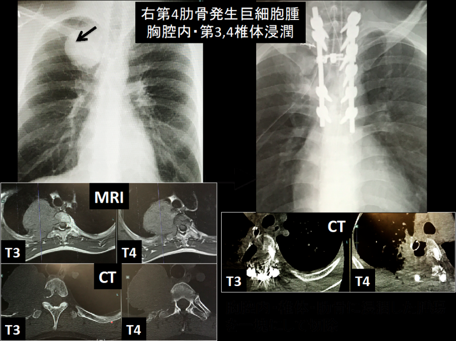 原発性・転移性脊椎腫瘍、脊髄腫瘍に対する手術写真1