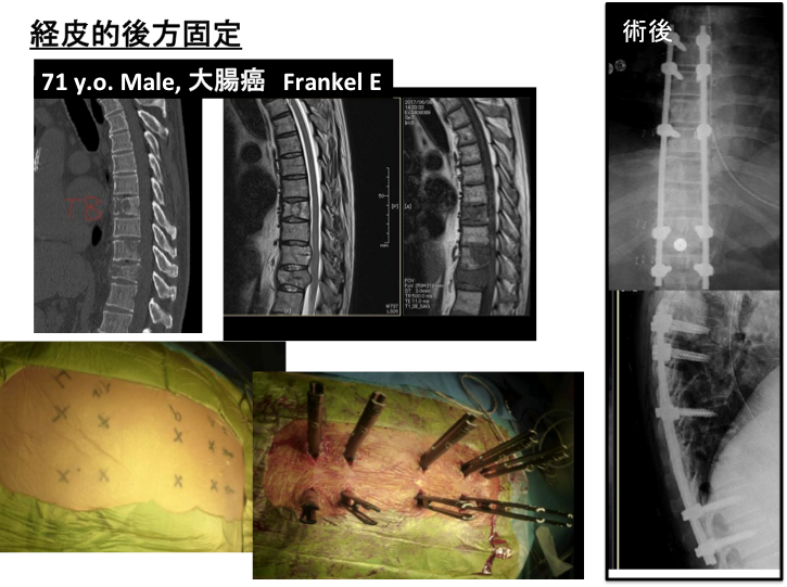 原発性・転移性脊椎腫瘍、脊髄腫瘍に対する手術写真2