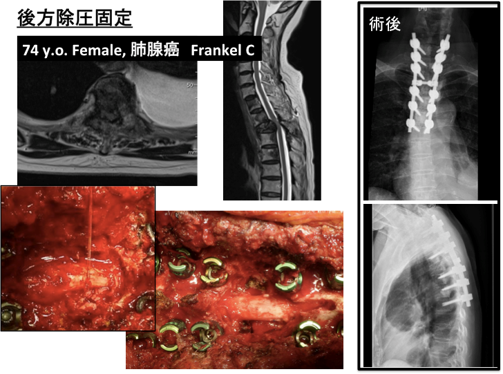 原発性・転移性脊椎腫瘍、脊髄腫瘍に対する手術写真3