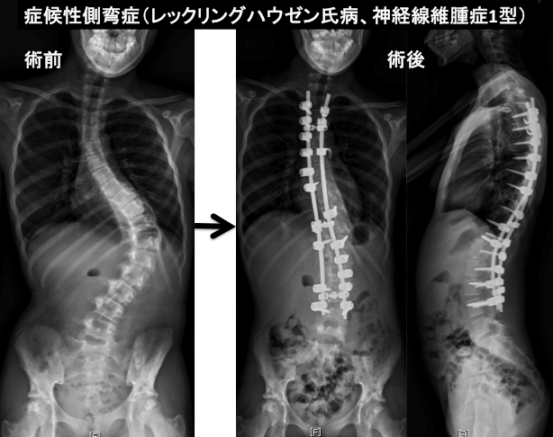 症候性側弯症(レックリングハウゼン氏病、神経線維腫症1型)