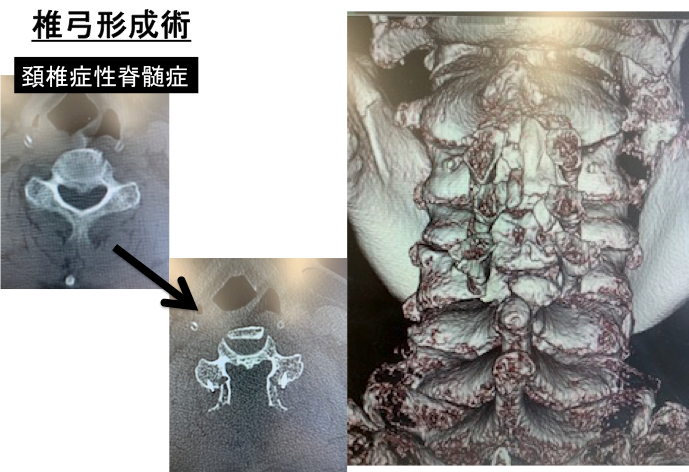 椎弓形成術