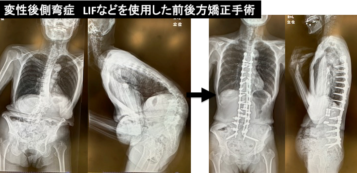 側弯症