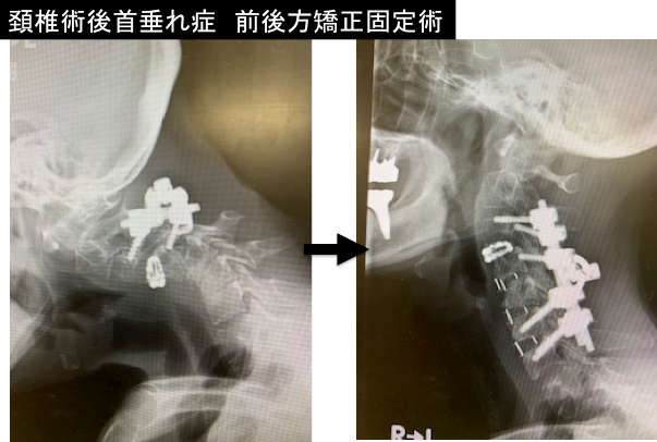頚椎固定術1