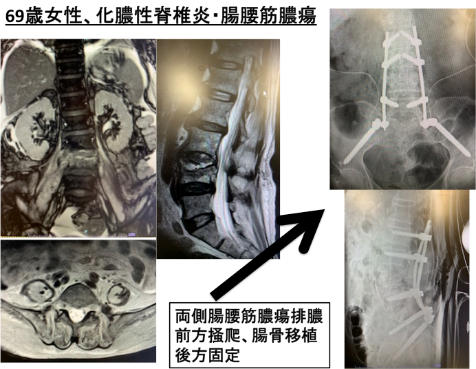 化膿性脊椎炎に対する治療2