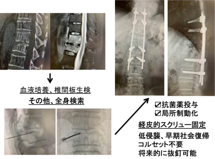 化膿性脊椎炎に対する治療1