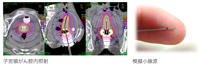 密封小線源放射線治療