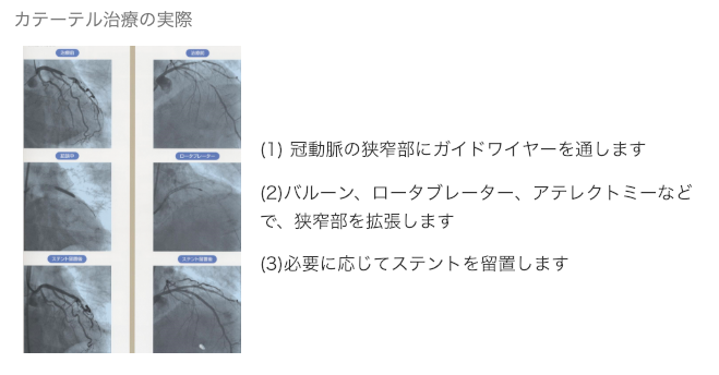 カテーテル治療の実際