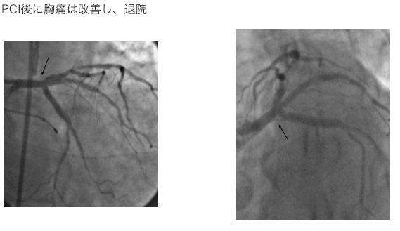 PCI後に胸痛は改善し、退院