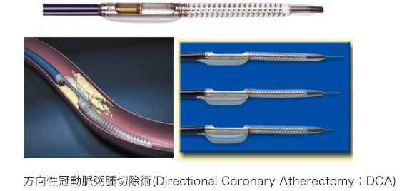 方向性冠動脈粥腫切除術(Directional Coronary Atherectomy；DCA)
