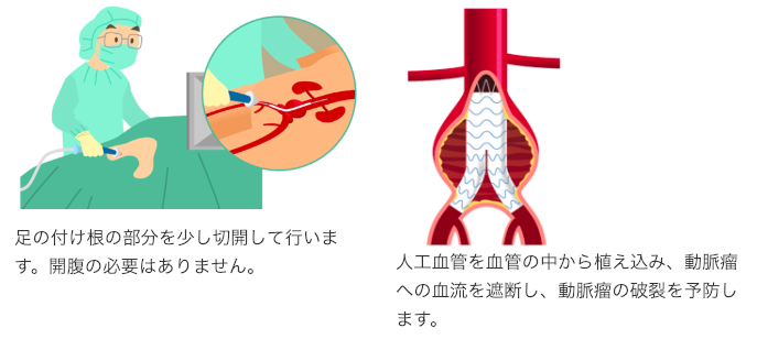 大動脈瘤に対するステントグラフト治療
