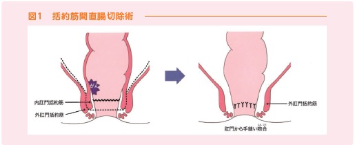 直腸切除術
