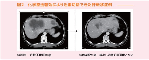 化学療法著効により治癒切除できた肝転移症例