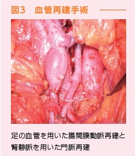 血管再建手術