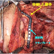 移植した腓骨