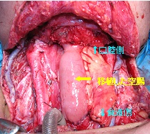 咽喉頭食道摘出術