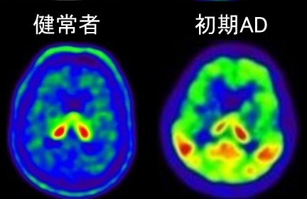 図：研究所で行っているPETタウイメージング(院内合成[18F]PM-PBB3による)