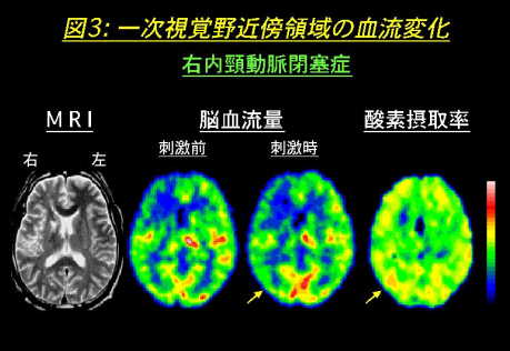 一次視覚野近傍領域の血流変化の図