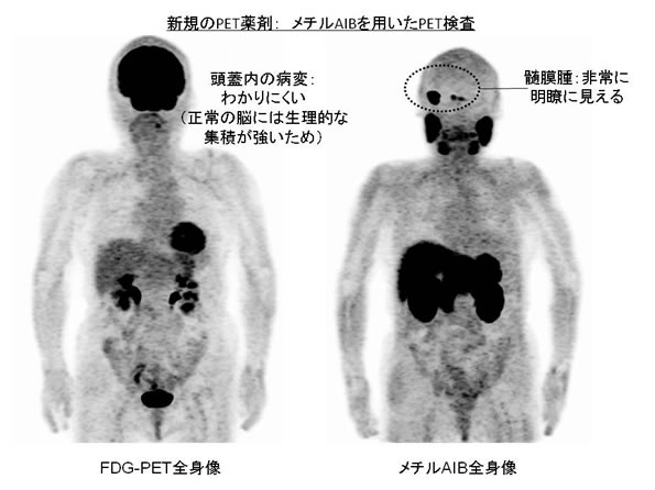 新規のPET薬剤:メチルAIBを用いたPET検査
